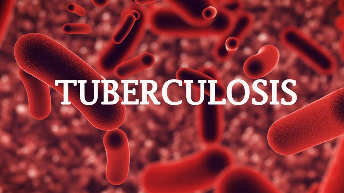 Tuberculosis: Institute raises alarm over high rate of death in Ogun